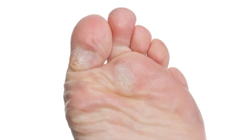 Treating Blisters